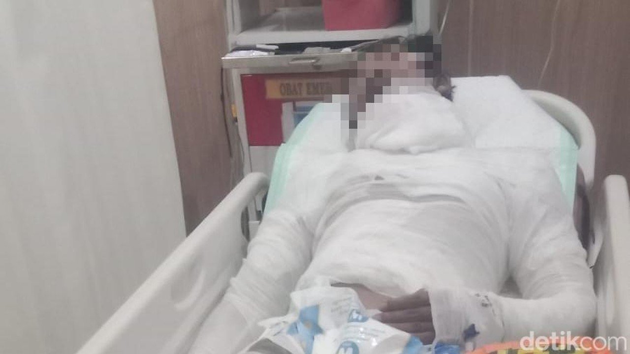 Sopir Truk Meninggal Akibat Luka Bakar Parah Pasca Dibakar Bos di Bali